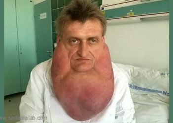 سلوفاكيا...استئصال ورم أكبر من الرقبة